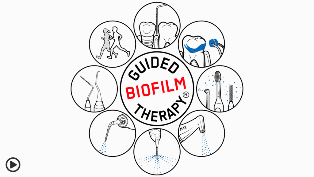 Video – Die Guided Biofilm Therapy in der Anwendung